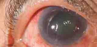 Glaucoma - Bệnh glaucoma là gì, bài thuốc trị cườm nước