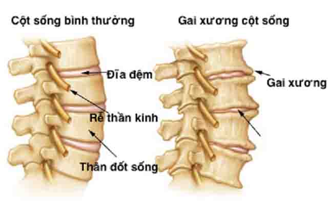 Bệnh gai cột sống quản và cách điều trị hiệu quả
