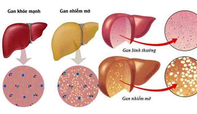Bệnh học gan nhiễm mỡ