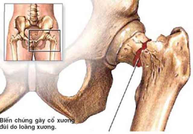 Bệnh loãng xương có nguy hiểm không