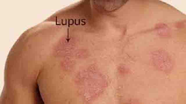 Bệnh lupus ban đỏ có lây không