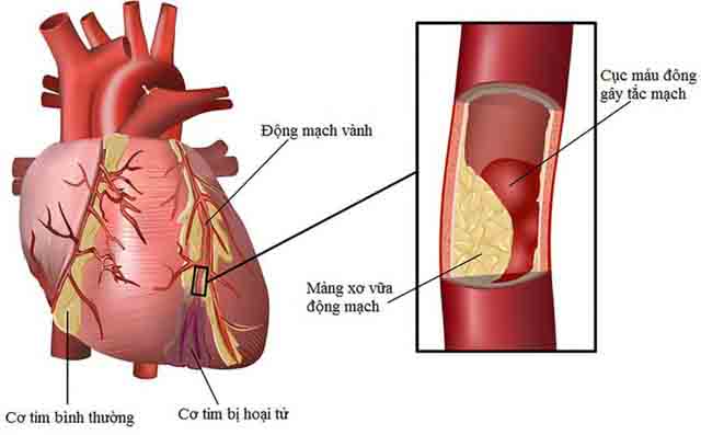 Thuốc điều trị bệnh mạch vành