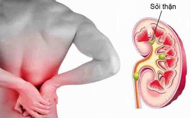 Bệnh sỏi thận và cách điều trị hiệu quả