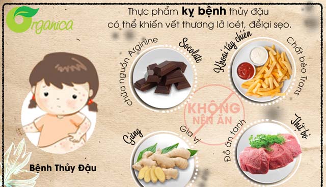 Bệnh thủy đậu kiêng gì