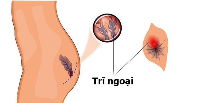 Viêm đại tràng và cách điều trị hiệu quả