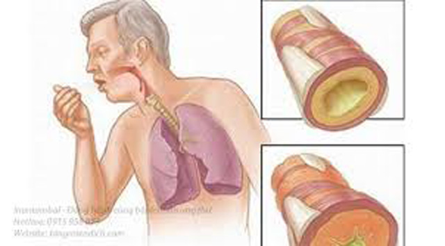 Bệnh ung thư phổi sống được bao lâu