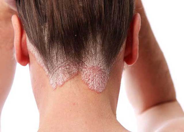 Bệnh vảy nến có lây không