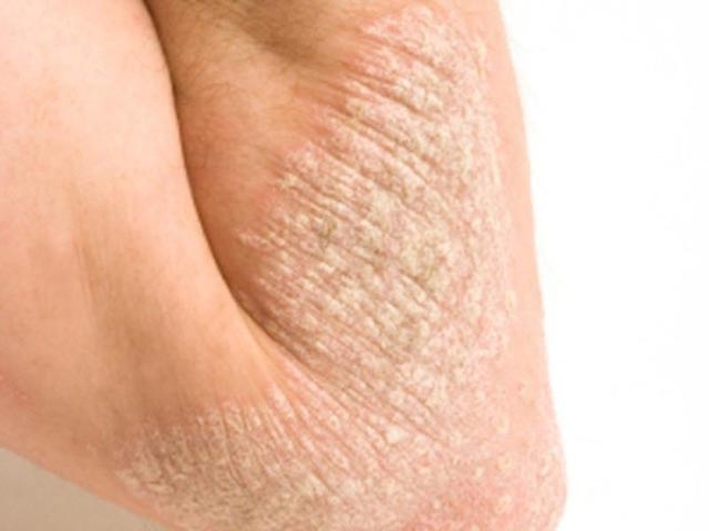 Bệnh chàm và cách điều trị hiệu quả