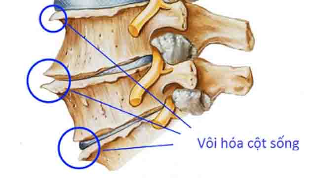 Bệnh vôi gai cột sống