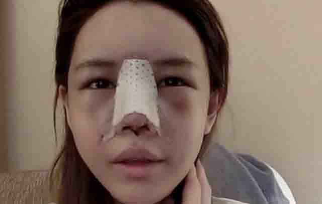 Biến chứng nâng mũi - Hướng xử trí các biến chứng thường gặp nâng mũi, có sao không