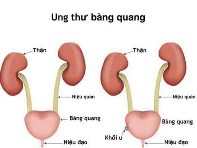 Biến chứng sỏi bàng quang