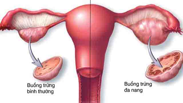 Buồng trứng đa nang – Hướng điều trị và phòng bệnh buồng trứng đa nang, nguyên nhân