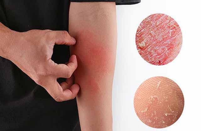 Các bệnh ngứa về da