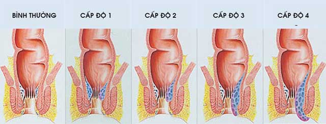 Các cấp độ bệnh trĩ