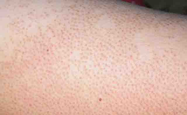 Viêm nang lông - Tìm hiểu các dạng viêm nang lông, biến chứng