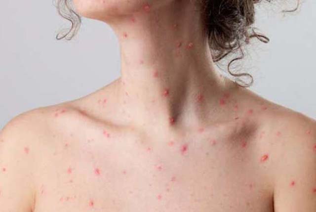 Cách chữa bệnh thủy đậu ở người lớn