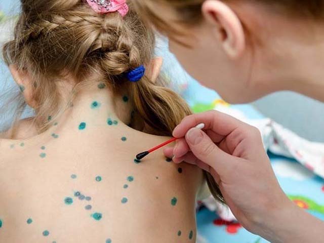 Cách chữa bệnh thủy đậu ở trẻ em