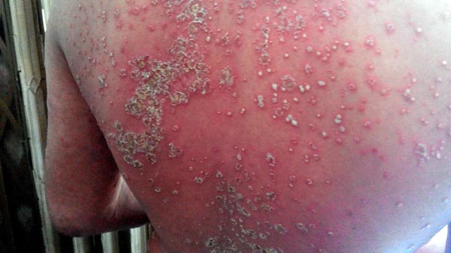 Cách chữa bệnh vảy nến