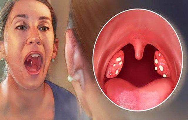 Cách chữa viêm họng kéo dài