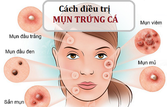 Cách điều trị mụn trứng cá