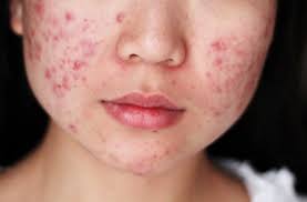 Cách giải độc gan trị mụn