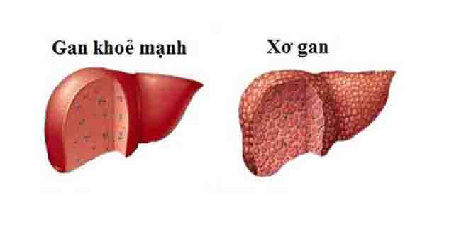 Cách nhận biết các bệnh về gan