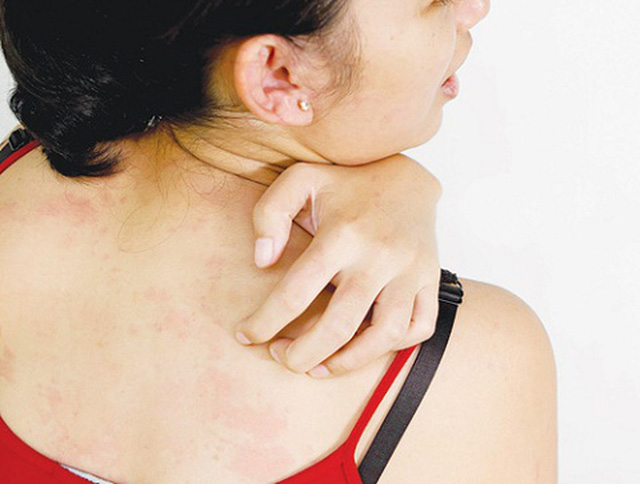 Cách phòng chống bệnh hắc lào