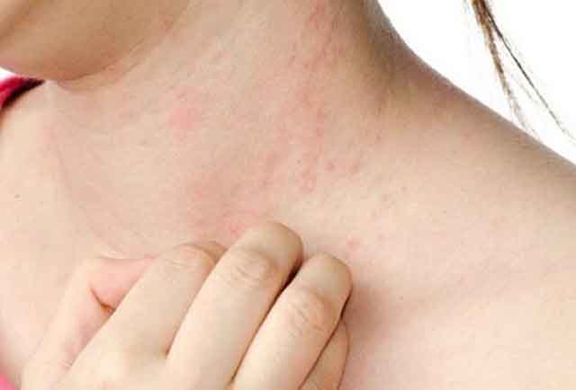 Cách trị ngứa da toàn thân