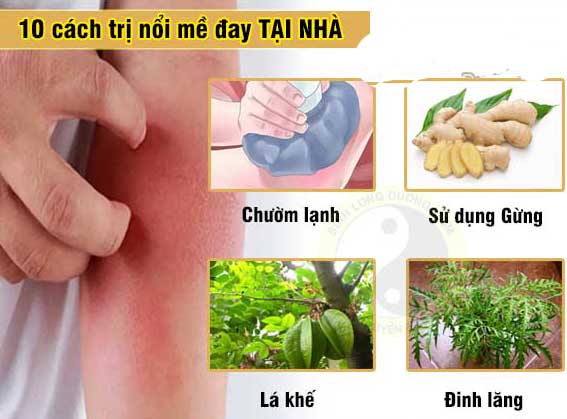 Cách trị nổi mề đay tại nhà cho trẻ