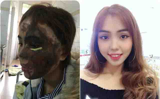 Bị tạt axit - Tìm hiểu cách xử trí khi bị tạt axit