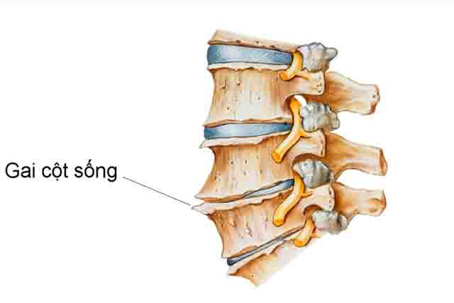 Cao dán trị gai cột sống