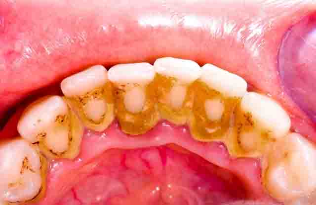 Cạo vôi răng và cách điều trị hiệu quả
