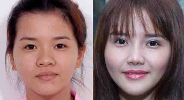 Cắt mí sau 6 tháng