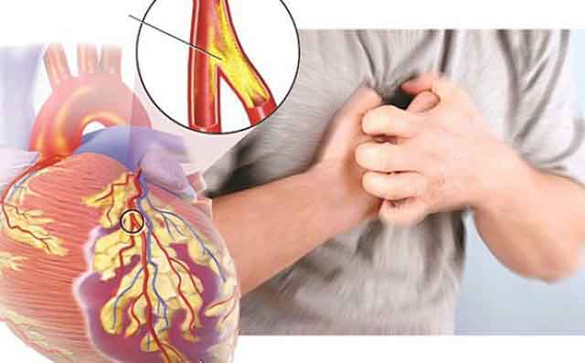 Chẩn đoán bệnh mạch vành
