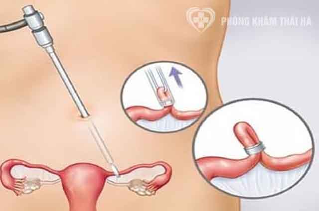 Chi phí điều trị tắc ống dẫn tinh