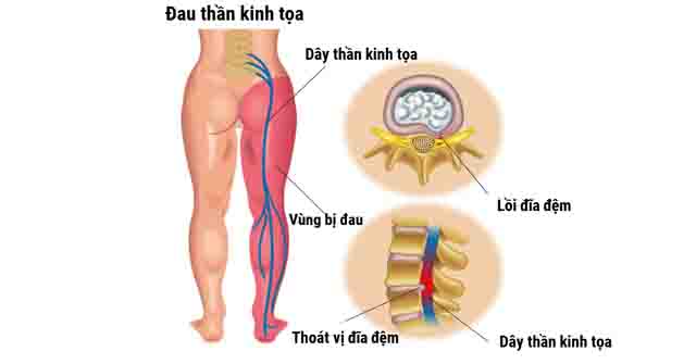 Đau dây thần kinh tọa - Một số dấu hiệu nhận biết đau dây thần kinh tọ