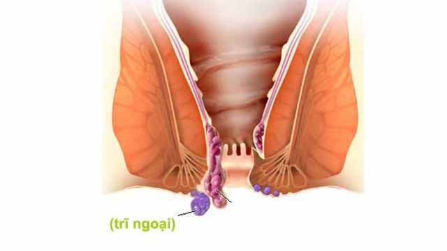 Dấu hiệu bệnh trĩ ngoại