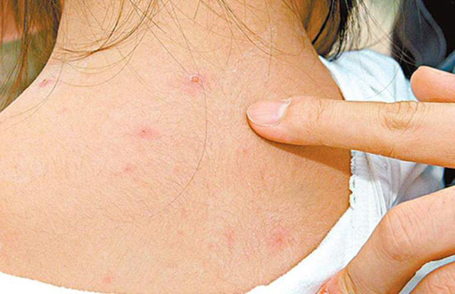 Dấu hiệu khỏi bệnh thủy đậu