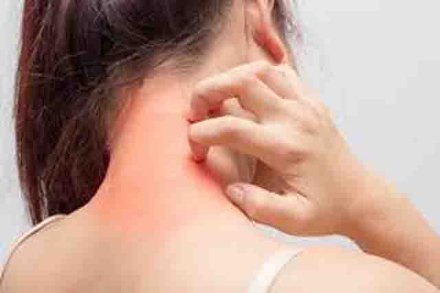 Dị ứng thực phẩm - Những dấu hiệu biểu hiện dị ứng thực phẩm, phòng tránh