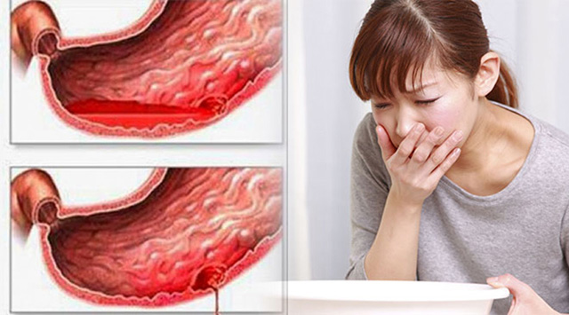 Điều trị xuất huyết dạ dày