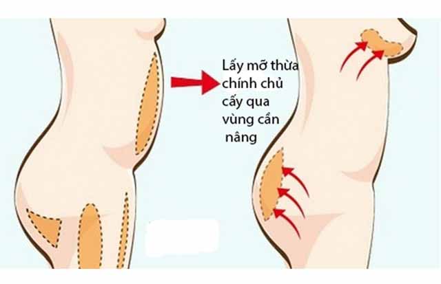 Giá nâng ngực