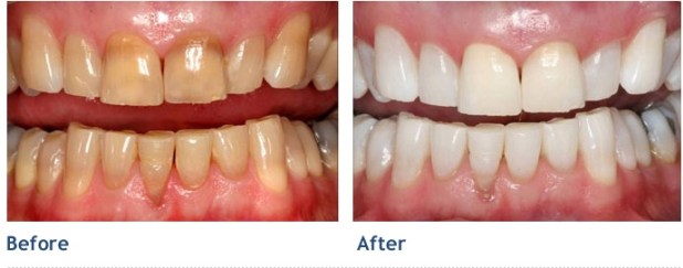 Giá tẩy trắng răng ở bệnh viện Răng Hàm Mặt