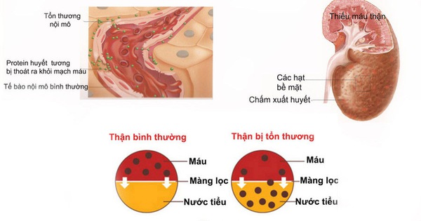 Hậu quả của bệnh sỏi thận