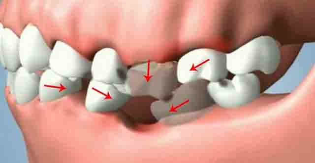 Mất răng - Tìm hiểu những hậu quả khi bị mất răng