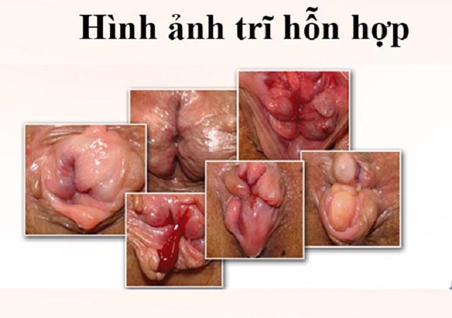 Hình ảnh bệnh trĩ