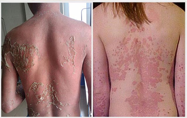 Cách chữa bệnh vảy nến