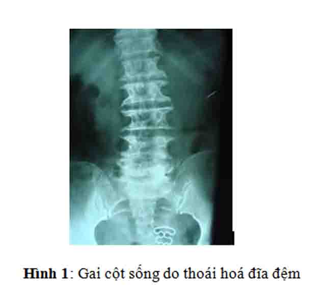 Hình ảnh gai cột sống thắt lưng