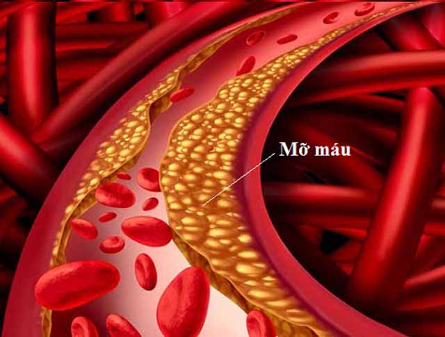 Máu nhiễm mỡ - Triệu chứng máu nhiễm mỡ, hình ảnh