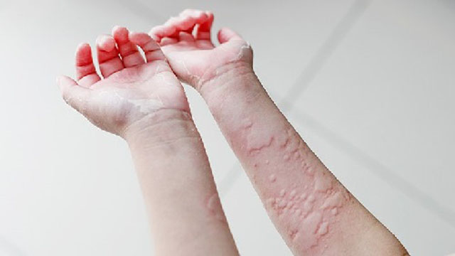 Hình ảnh nổi mề đay