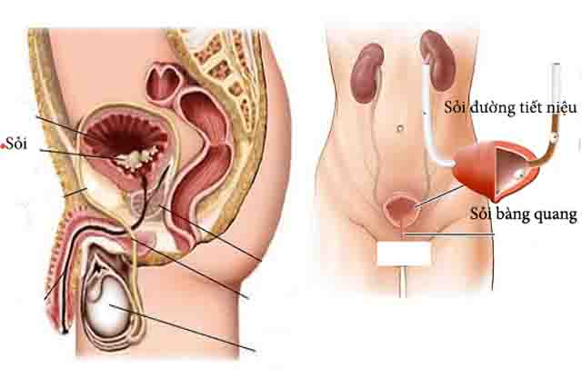 Hình ảnh sỏi bàng quang